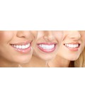 Teeth SparkleWhite® Professional Whitening 3D blanchissant At Home Système complet - Résultats professionnels garanti!